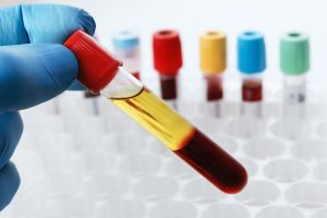 Serum blood alcohol test compared with whole blood in a Michigan DUI case